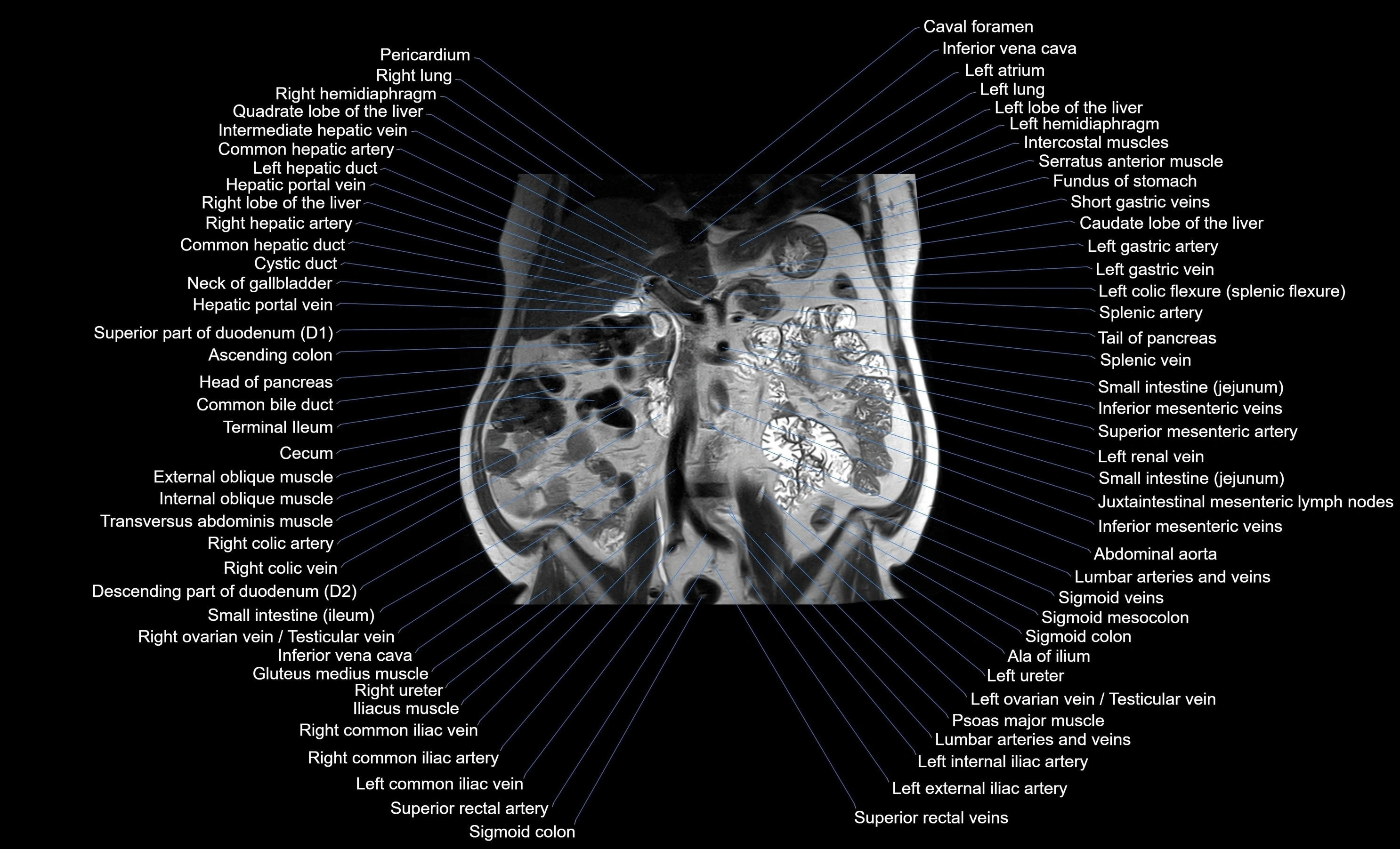 MRI Abdomen coronal labelled cross sectional anatomy radiology  image-img-00001-00029.webp